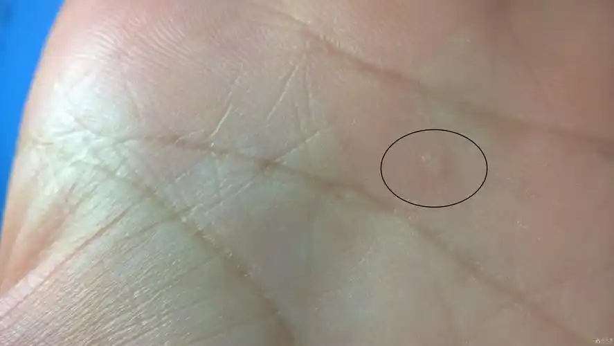 手上长了个小疙瘩给看看是什么