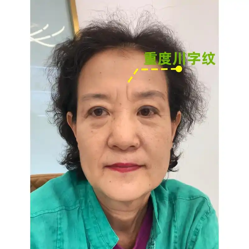 川字纹切除不损伤皱眉肌,靠谱吗,能保持多久,有没有后遗症?