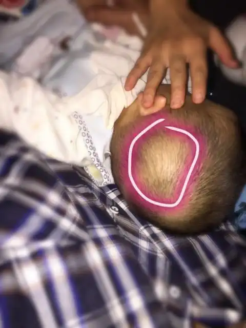 宝宝头上这里起了一个软包.今天也没摔下午2点多突然发现的.