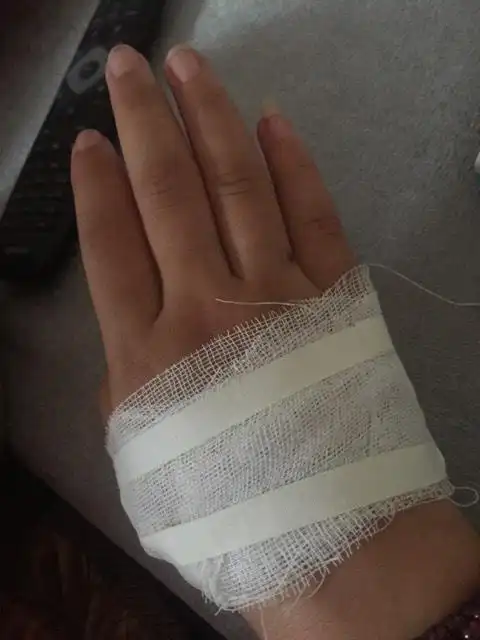 手被人咬了一口,肿起来了,去药店擦了药水,要紧吗?