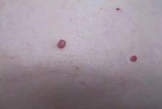 胆经|柴胡|肝胆|血痣|蜘蛛|肝硬化_网易订阅