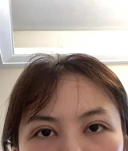 肿眼泡埋线第21天_肿眼泡_双眼皮手术_美妆_医美整形