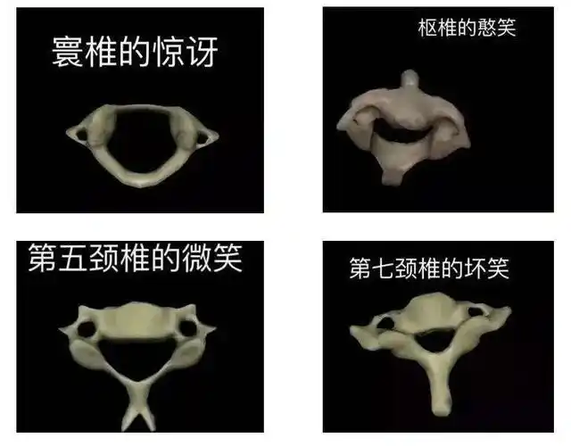 同样是颈椎间盘为何你如此突出