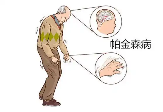 帕金森晚期能活多久帕金森综合症能活几年