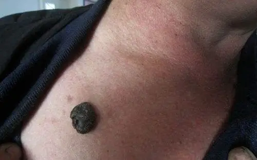 良性黑色素瘤早期切除了