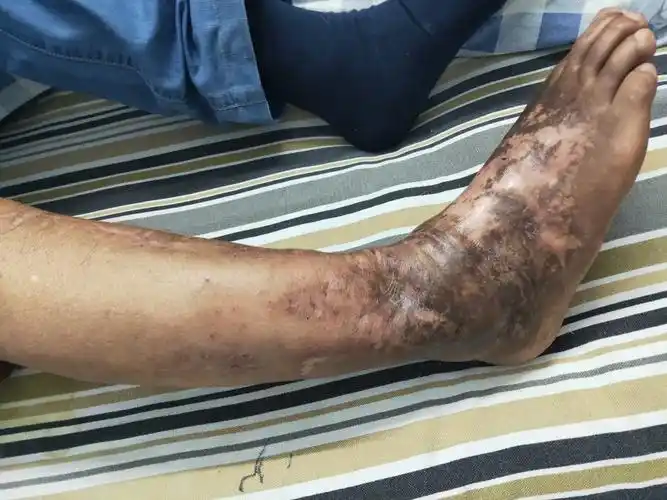 骨折后骨头不长怎么办