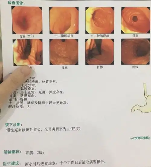 简单记录第一次做胃镜