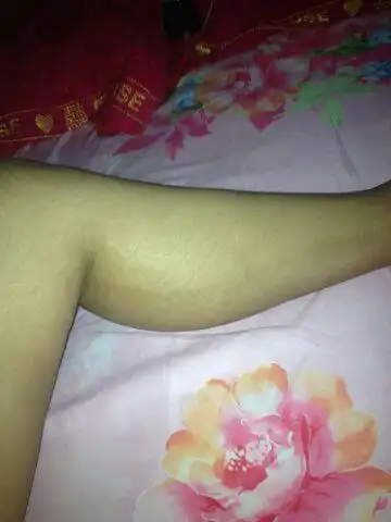 怀孕8个月了,今天突然发现大腿内测黑一边白一边的, | 妈妈网轻聊