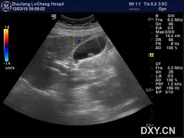 【请教】胆囊息肉有血流吗? - 超声医学 -丁香园论坛