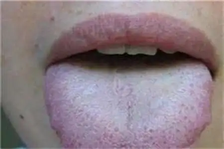 着床后喉咙疼是怎么回事