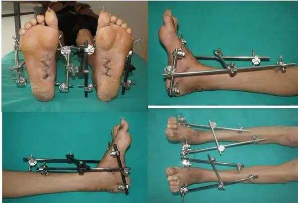 手术后,佩戴支架外观取出支架后外观,站立位不同侧面观最终侧位静息观