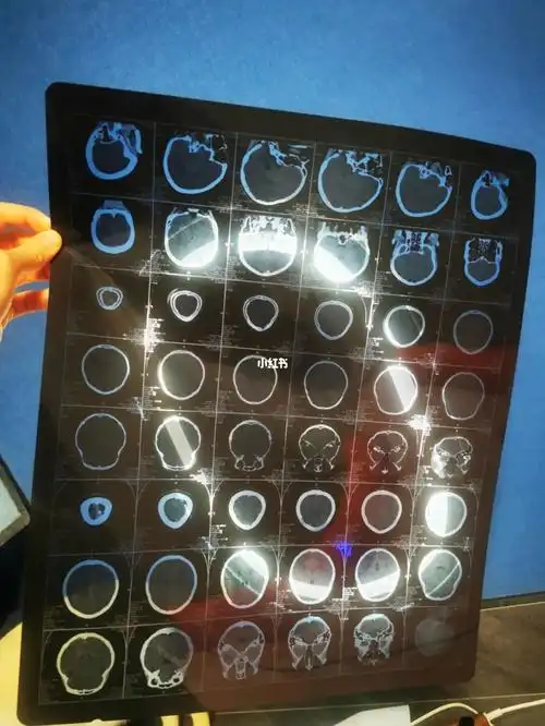 一起滑雪吗轻微脑震荡送一张脑ct的那种