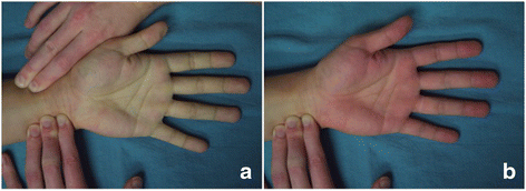 era of trans radial endovascular access proceduresallens试验
