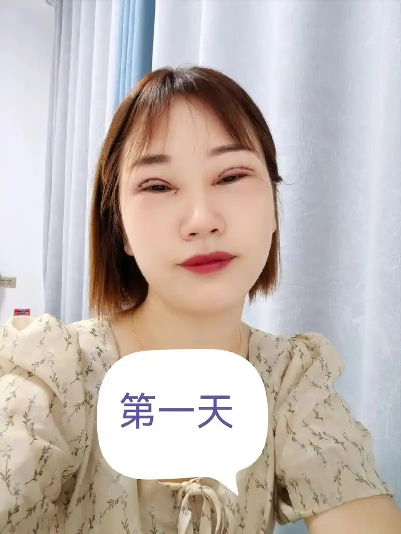 经历了一个难忘星期的过程,还要三个月的忌口#双眼皮恢复记录 - 抖音