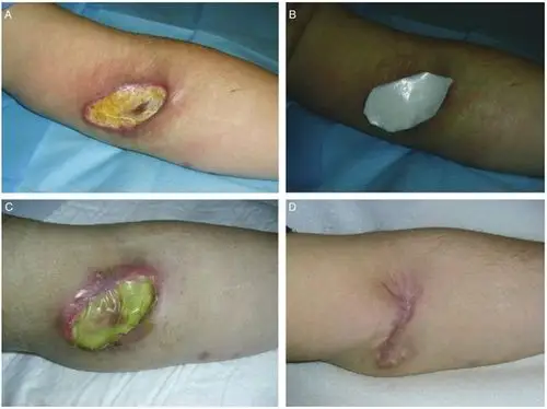 胶原酶和透明质酸:清创效果好 加快创口愈合