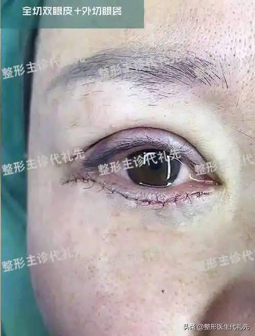 代医生,祛眼袋手术多久可以恢复?