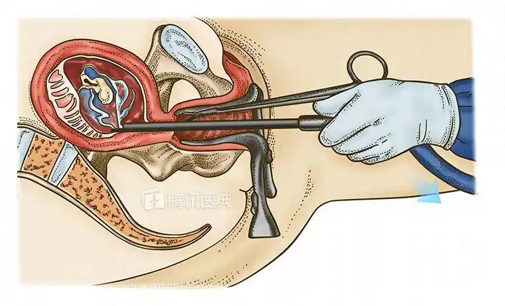 如果确定要做人工流产,建议越早越好.