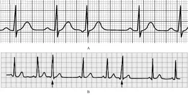 交界性期前收缩