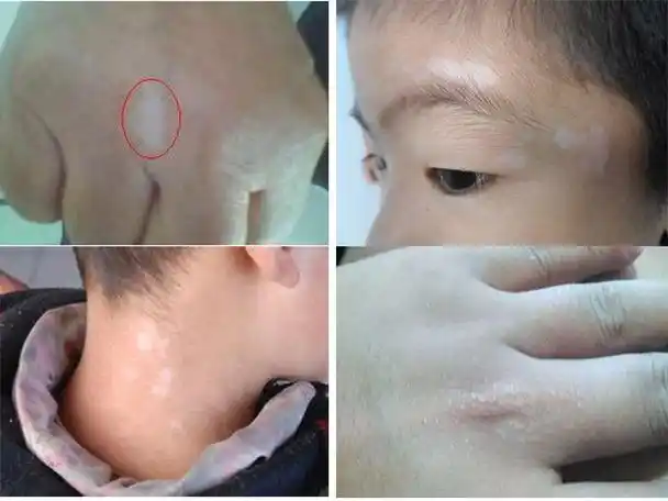 身上出现小白点怎么办