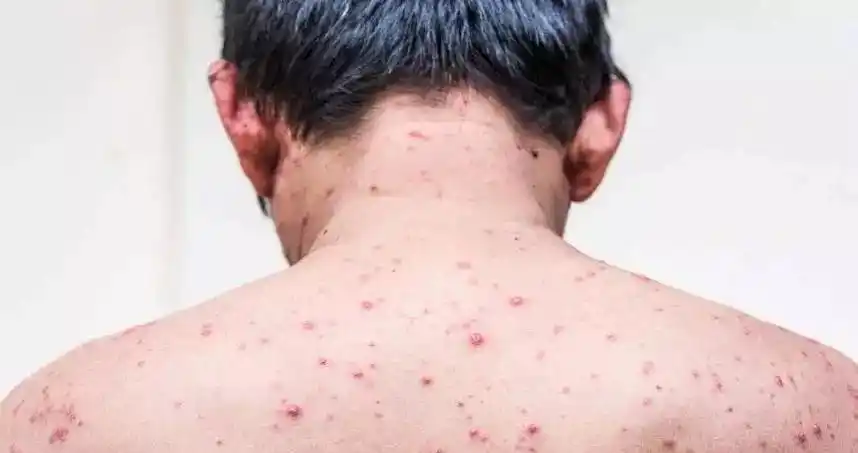 知艾防艾 艾滋病初期症状图片描述