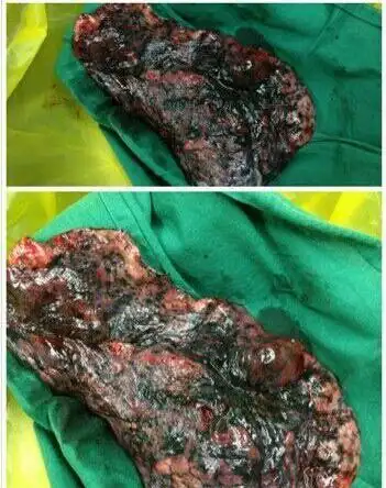 网友发布吸烟者肺部照片 黑色烟熏肺吓呆烟民(图)