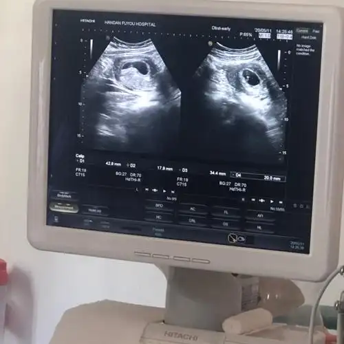 各位宝妈有能看懂的嘛 能不能看孕囊看男女宝宝