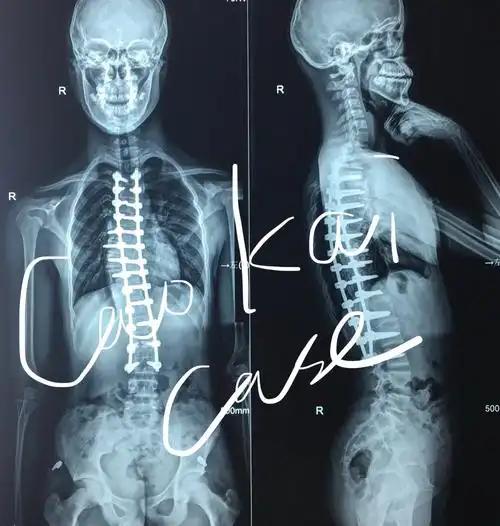 青少年特发性脊柱侧弯