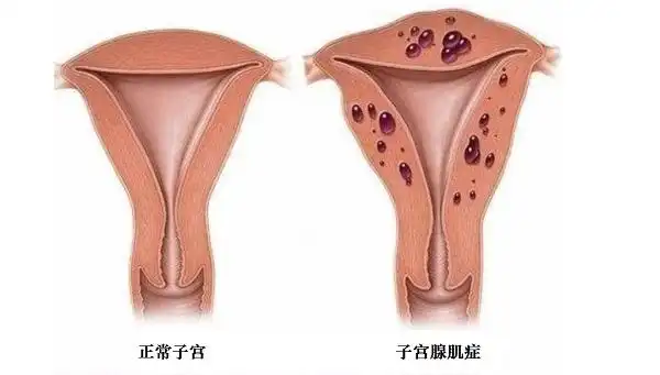 39岁患有子宫腺肌症想怀孕可以做人工受孕吗