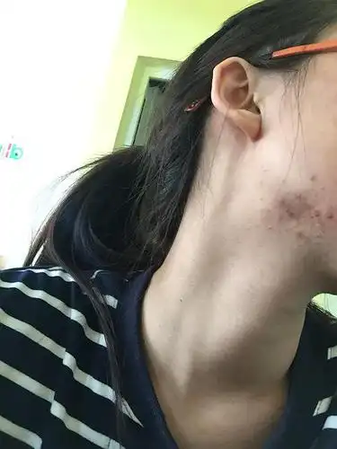 总是两边下颌骨起痘是为什么呢.