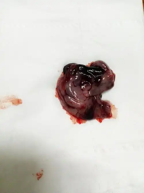 孕早期30天自然流产,三天后傍晚肚子闷闷的疼,排出一块脚趾头般大的