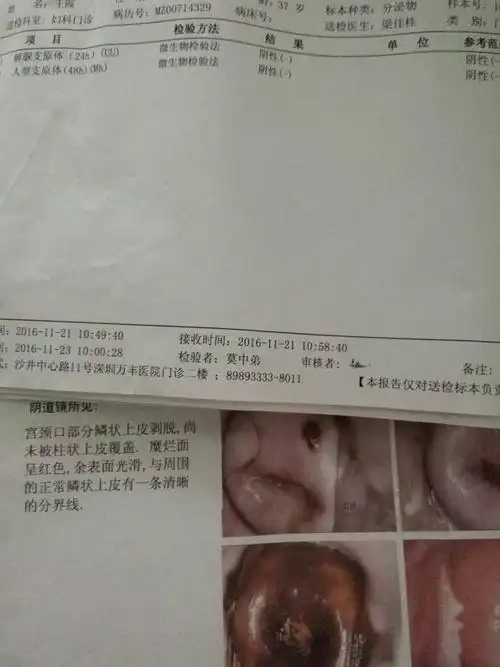 非典型鳞状细胞不能明确意义吃了消炎药后有东西从阴道排出要紧吗