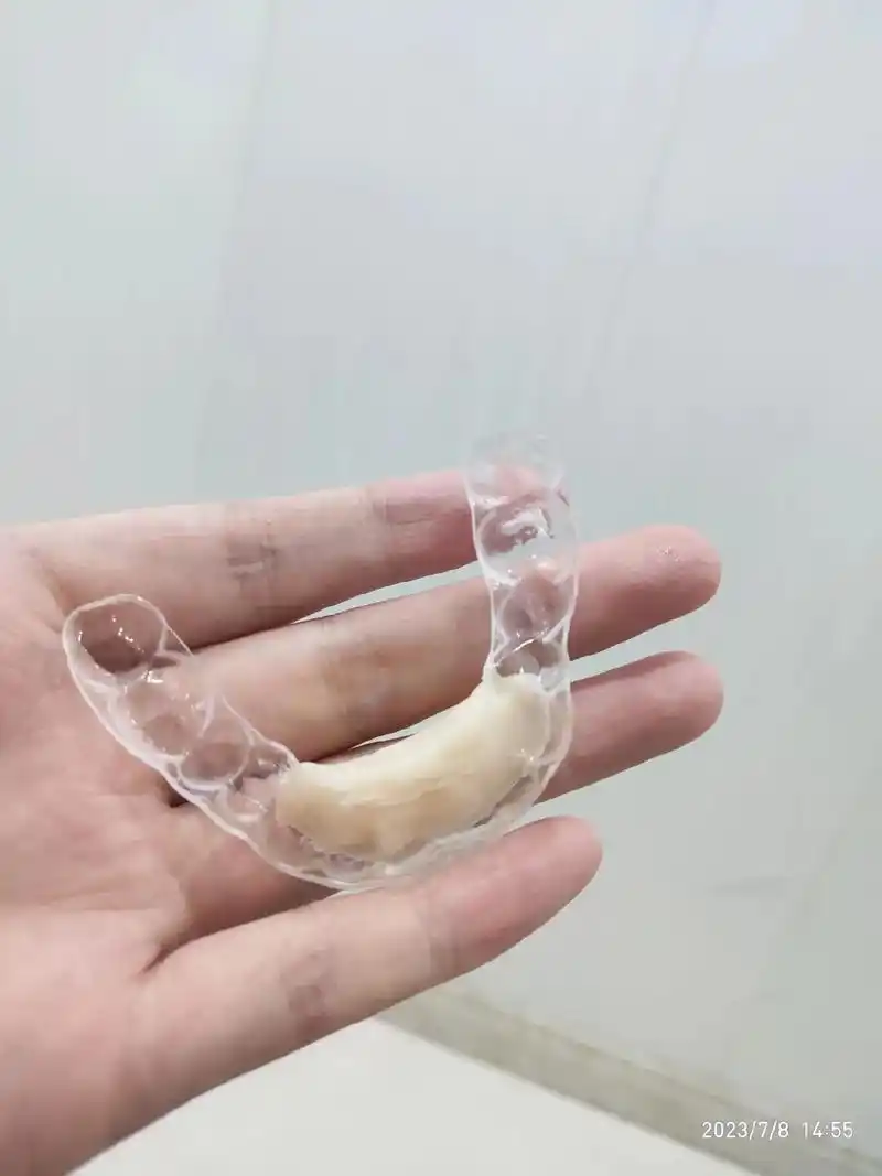 深覆合正畸大军集合啦～平导带了61天可以摘下了,下一个不知道 - 抖音