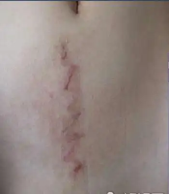 现在的医生大都会选择横切,如果不是疤痕体质疤痕就不会明显.