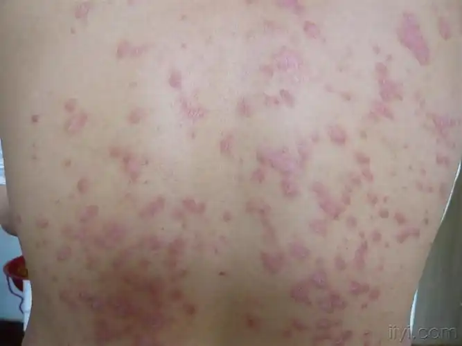 请大家帮忙诊治朋友身上的皮肤病有照片