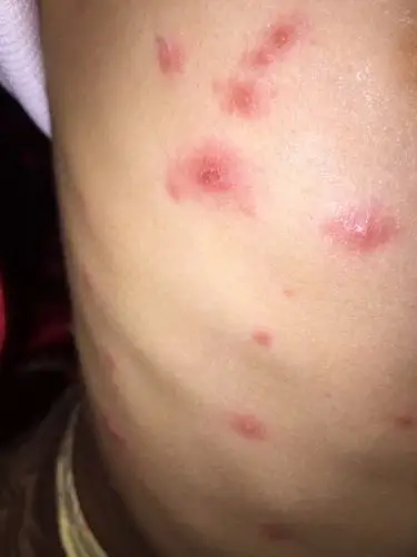 5周岁女孩身上长满这种疙瘩,请问这是什么病?