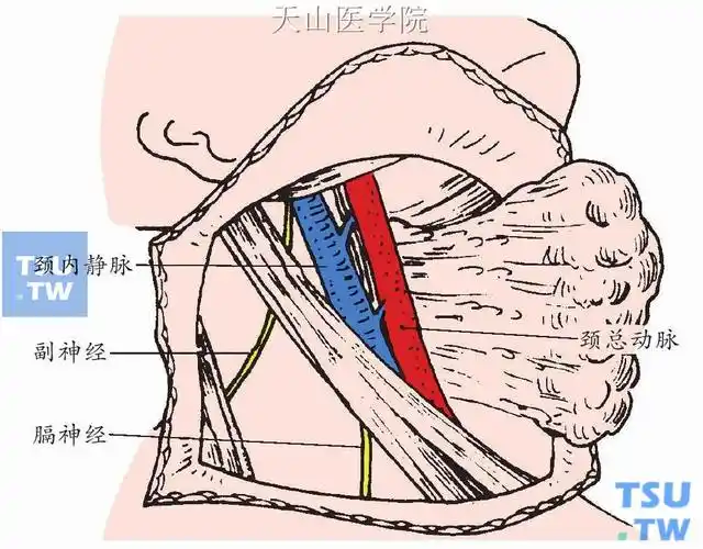 贴近颈内静脉前缘结扎切断进入此静脉的面总静脉和甲状腺上,中静脉,使