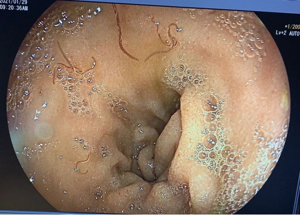 小小钩虫致大病