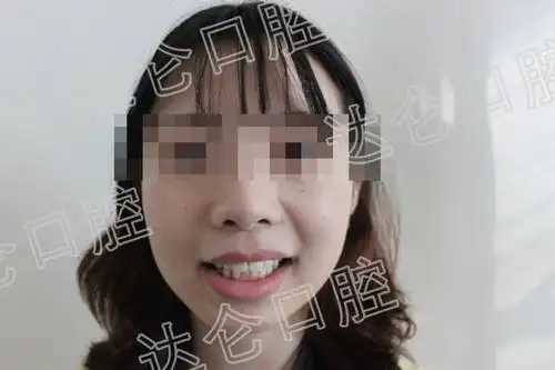 真实案例牙齿中线不齐导致嘴歪如何通过牙齿矫正改变
