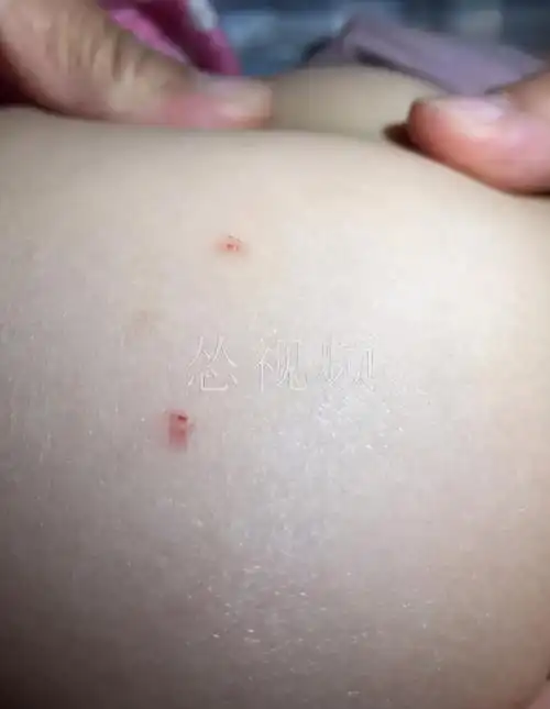 大连东方瑞吉欧幼儿园多名幼儿身上现针眼孩子老师扎的