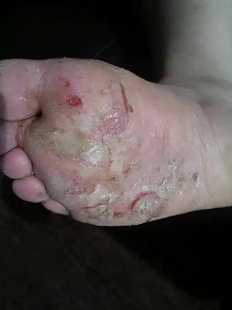 主要是由真菌感染,主要症状是瘙痒,脱皮,糜烂,臭味,具有极强的传染性.