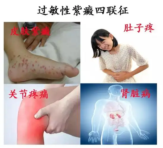 iga血管炎(过敏性紫癜)能彻底好吗?能正常结婚生子吗?
