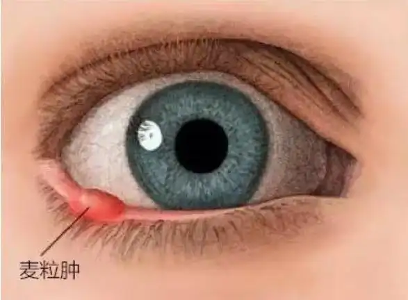 麦粒肿与霰粒肿,傻傻分不清?