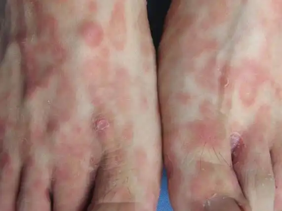 梅毒初期症状 (10)_有来医生