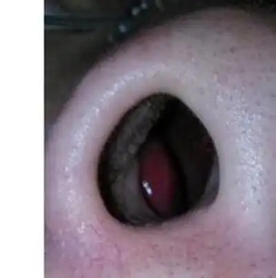 鼻窦炎症状图片 (44)