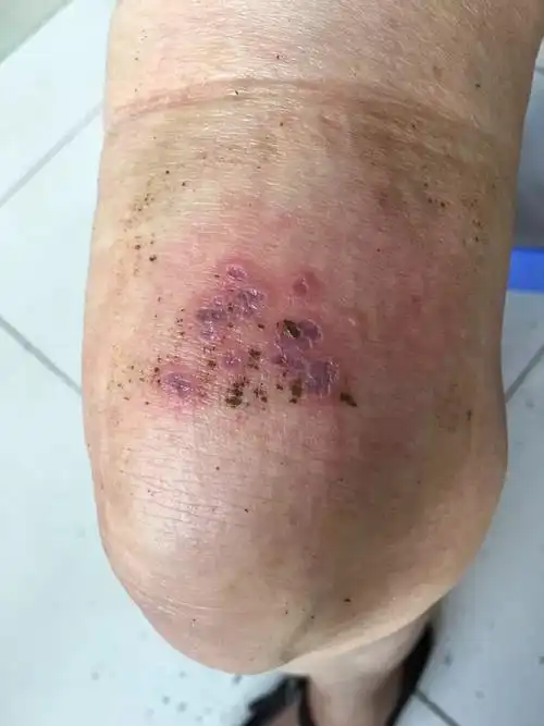 200多例带状疱疹的患者在我这,避免了留下后遗症的痛快,给我机会,我给