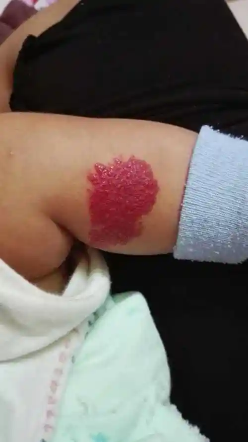 我家宝宝蛋蛋上长了个毛细血管瘤