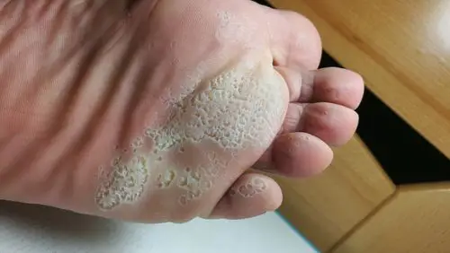 脚底皮损一例