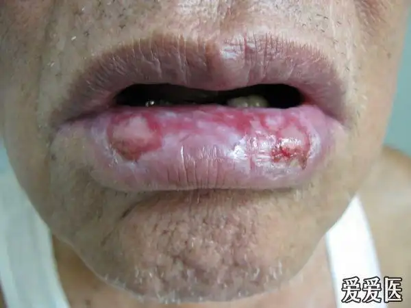 口腔粘膜糜烂----扁平苔癣?