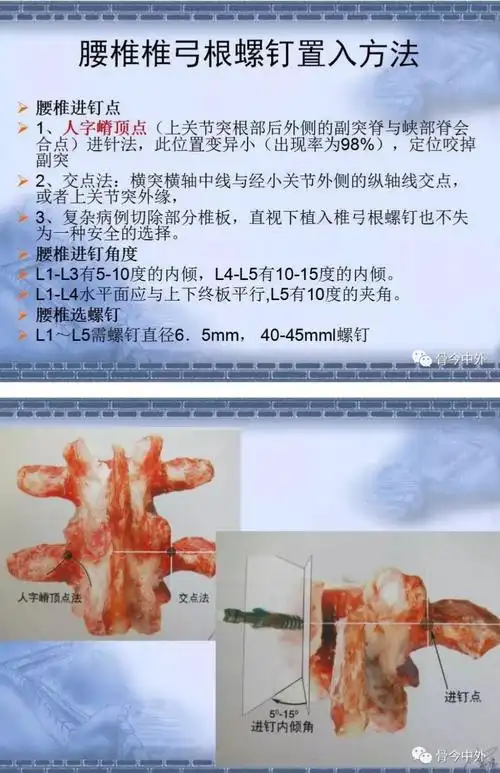 腰椎进钉点