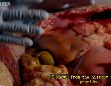 bbc纪录片解剖了一个大胖子,看完大家都想开始减肥了 | 画面刺激慎入